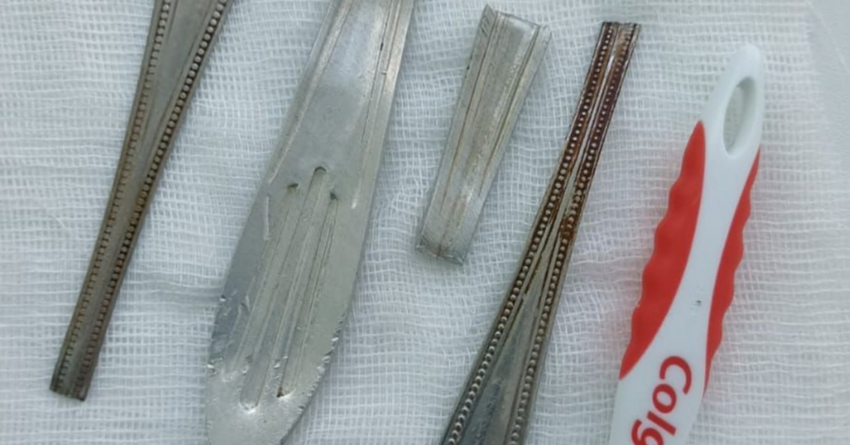 В Башкирии врачи извлекли из желудка пациента части ложек, вилок и зубной щетки. Фото: t.me/mash_batash