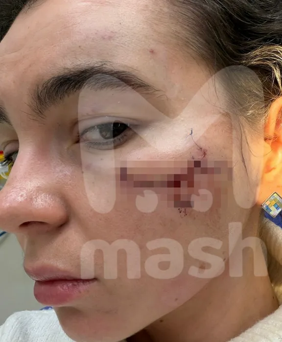 В Казани после концерта «Тату» изуродовали победительницу конкурса красоты. Фото: @breakingmash