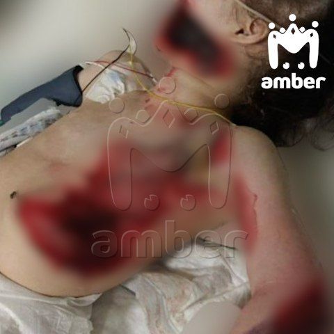 Девочка получила ужасающие ожоги, пролежав на батарее несколько часов. Фото: t.me/amber_mash