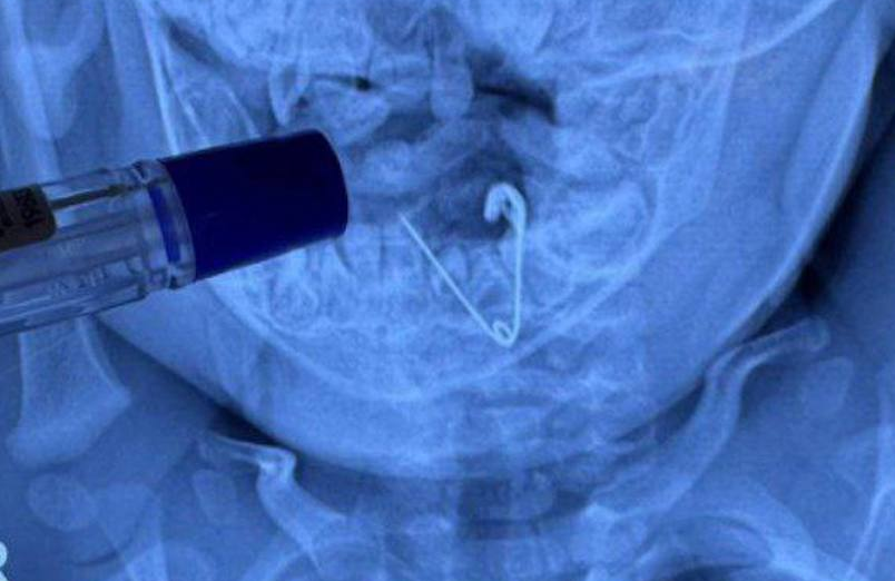 В Приморье младенец проглотил булавку, оставленную мамой в одеяле как оберег. Фото: t.me/amur_mash