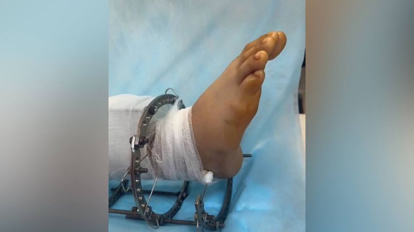 Мальчику восстановили ногу после серьезной травмы. Фото: vkvideo.ru/@roshal__clinic