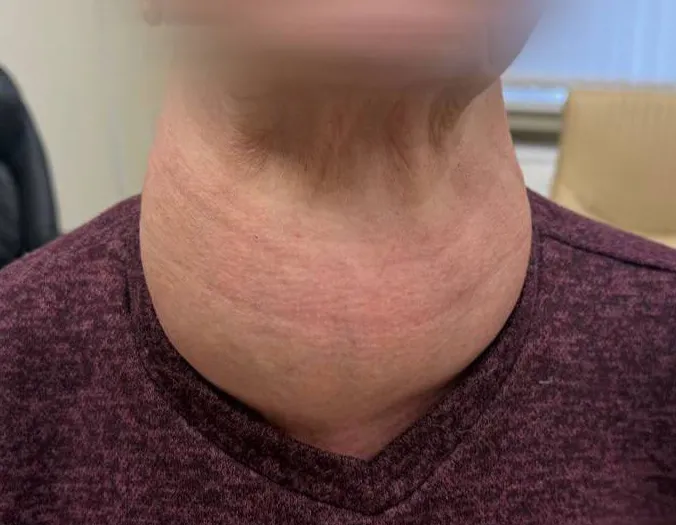 В Татарстане врачи спасли женщину, удалив щитовидку, выросшую до размеров головы. Фото: соцсети