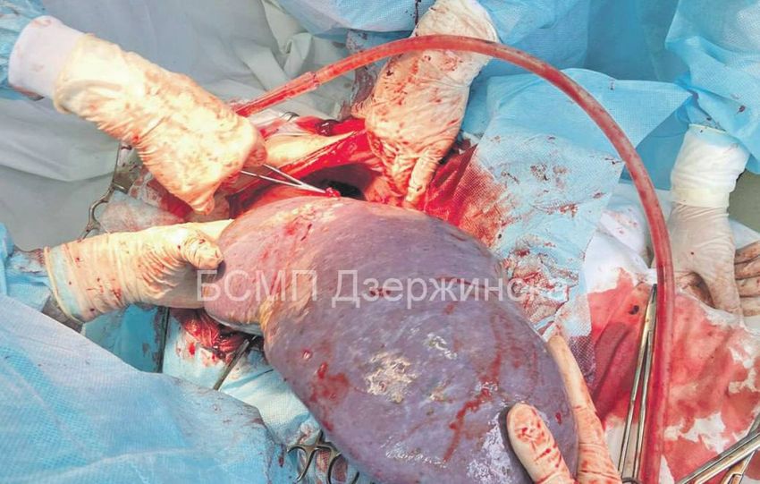 В Нижегородской области у женщины из-за болезни селезенка выросла до 40 на 25 см. Фото: t.me/mash_nimash