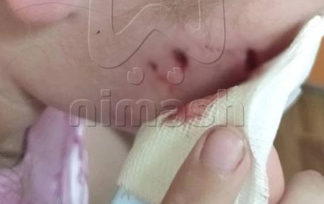 В Нижнем Новгороде домашняя собака напала на девочку и порвала ей лицо. Фото: t.me/mash_nimash