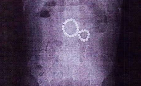 В Иркутске врачи спасли девочку, которую рвало кровью из-за съеденных магнитов. Фото: t.me/babr_mash