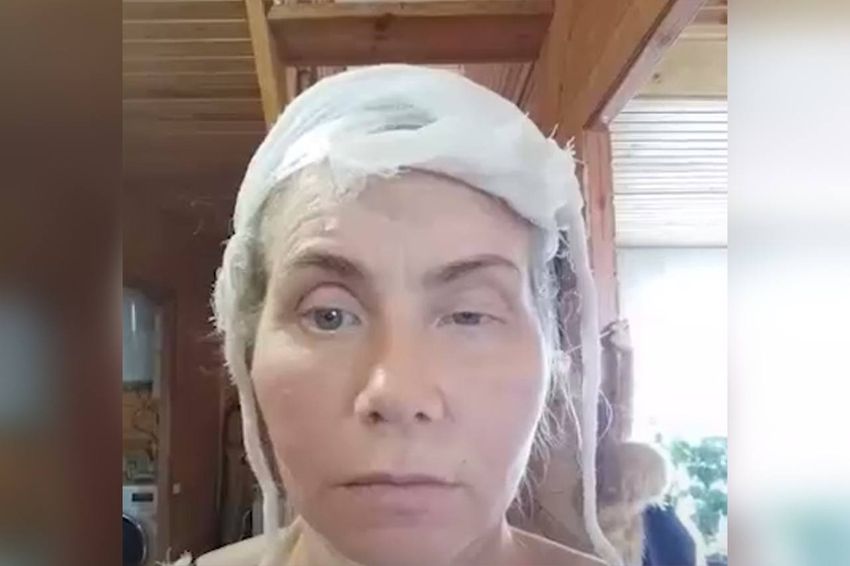 На Кубани стоматолог забыл тампон у пациентки в десне, и у нее провалился глаз. Фото: @t.me/kub_mash