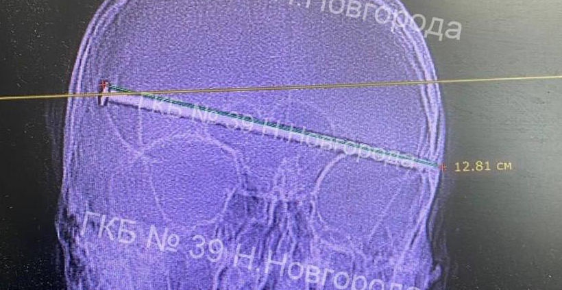 В Нижнем врачи спасли мужчину, которому 12-сантиметровый гвоздь пробил голову. Фото: t.me/mash_nimash