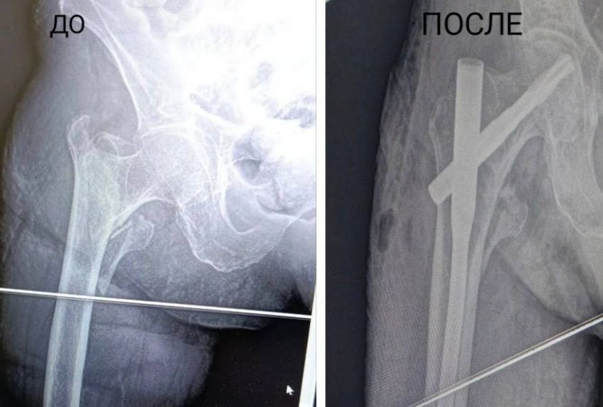 Все осколки зафиксировали металлическими штифтами. Фото: vk.com/minzdrav_mo