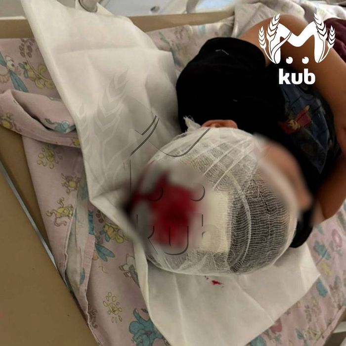 В Краснодаре врачи провели трепанацию черепа мальчику, которого сбил самокатчик. Фото: t.me/kub_mash