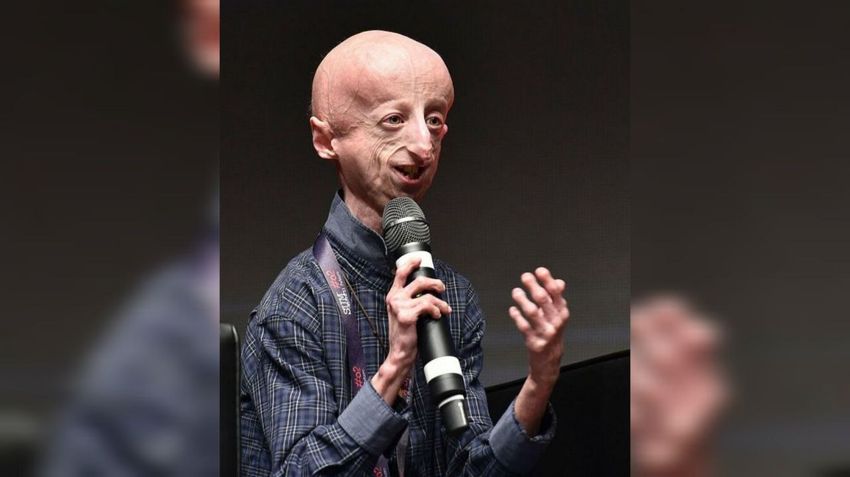 В Италии в 28 лет умер Сэмми Бассо - самый долгоживущий мужчина с прогерией. Фото: ilmessaggero.it