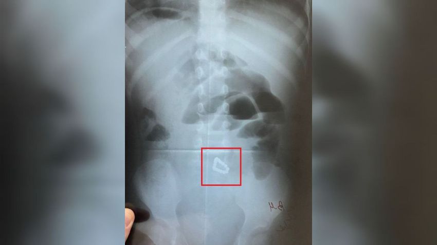 В Уфе у 2-летней девочки образовались дырки в кишечнике из-за проглоченных магнитов. Фото: t.me/mash_batash